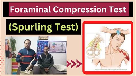 max foraminal compression test|foraminal compression test positive.